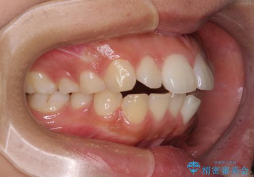 口が閉じられない 抜歯矯正で横顔の印象が劇的に変化の治療前