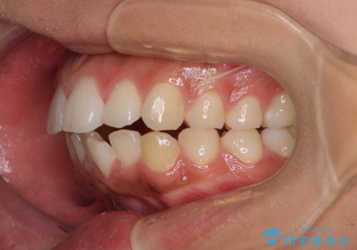 口が閉じられない 抜歯矯正で横顔の印象が劇的に変化の治療前