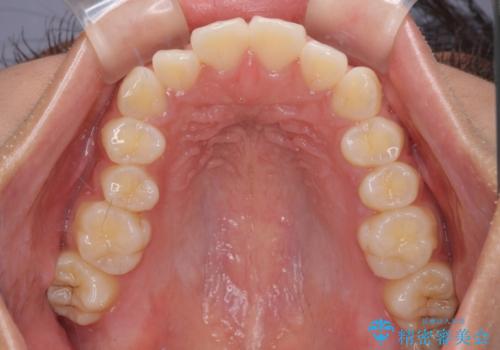口が閉じられない 抜歯矯正で横顔の印象が劇的に変化の治療前