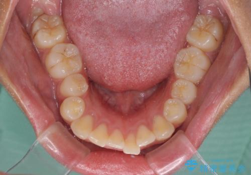 口が閉じられない　抜歯矯正で横顔の印象が劇的に変化の治療前