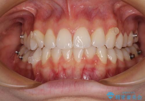 前歯のデコボコと深い咬み合わせ インビザラインできれいに改善の治療中