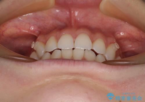 前歯のデコボコと深い咬み合わせ インビザラインできれいに改善の治療中