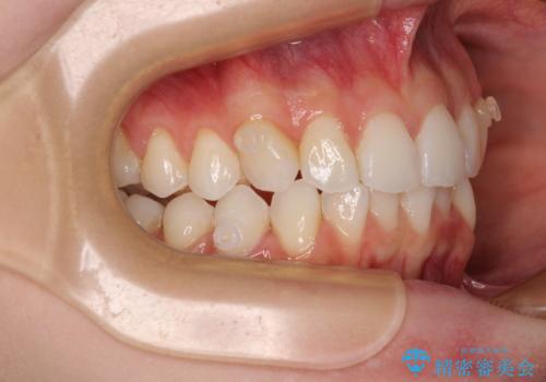 前歯のデコボコと深い咬み合わせ インビザラインできれいに改善の治療中