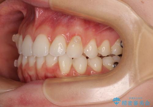 前歯のデコボコと深い咬み合わせ　インビザラインできれいに改善の治療中
