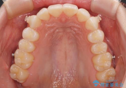 前歯のデコボコと深い咬み合わせ　インビザラインできれいに改善の治療中