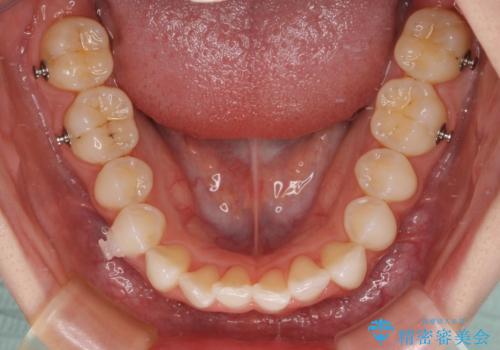 前歯のデコボコと深い咬み合わせ インビザラインできれいに改善の治療中