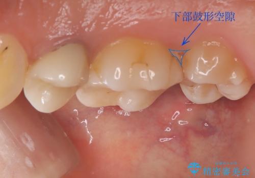 物が詰まりやすく歯茎が腫れるの治療前