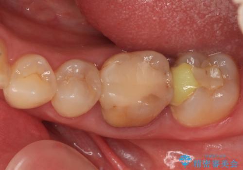 処置を先延ばしにしていたむし歯　奥歯のセラミック治療の治療前