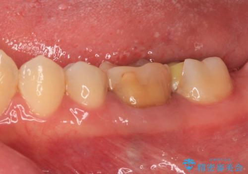 処置を先延ばしにしていたむし歯 奥歯のセラミック治療の治療前