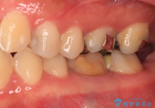 処置を先延ばしにしていたむし歯 奥歯のセラミック治療の治療前