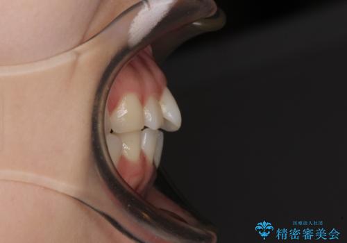 抜歯矯正へ切り替え　表側のワイヤー矯正の治療前