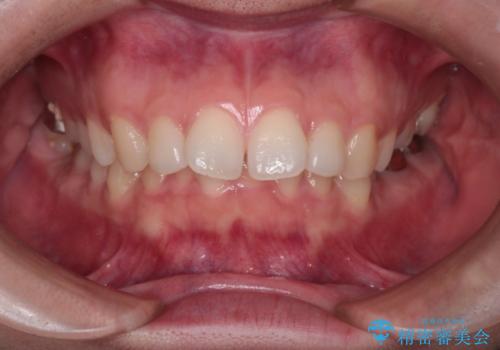 【インビザライン】前歯を引っ込めたいの治療前