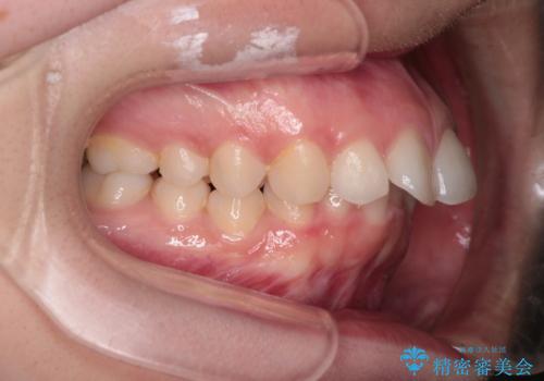 【インビザライン】前歯を引っ込めたいの治療前