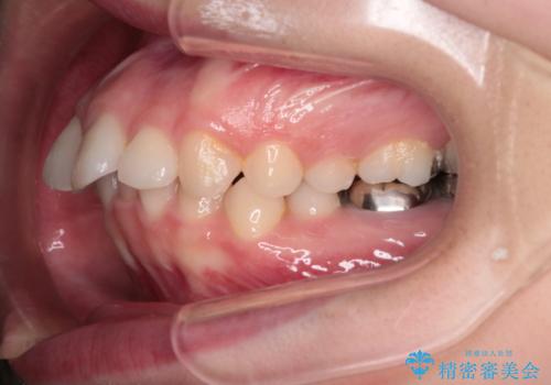 【インビザライン】前歯を引っ込めたいの治療前