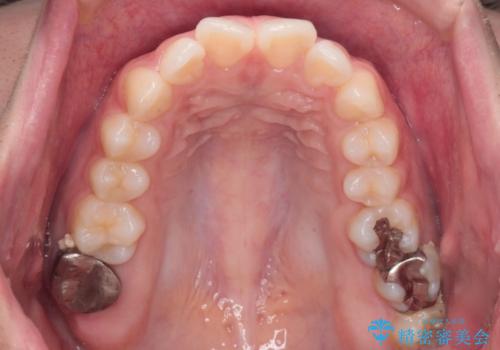 【インビザライン】前歯を引っ込めたいの治療前