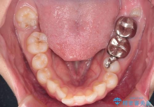 【インビザライン】前歯を引っ込めたいの治療前