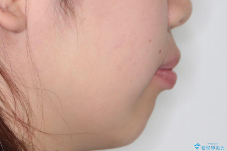 【インビザライン】前歯を引っ込めたいの治療前(顔貌)