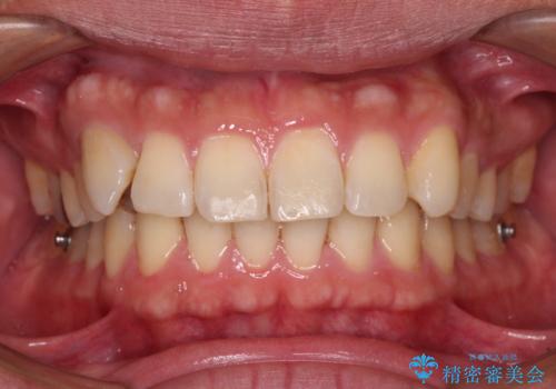 遠方からの通院 インビザライン矯正治療の治療中