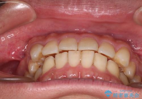 遠方からの通院 インビザライン矯正治療の治療中