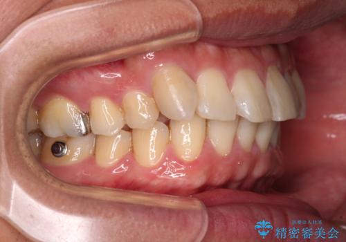 遠方からの通院 インビザライン矯正治療の治療中