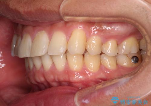 遠方からの通院 インビザライン矯正治療の治療中