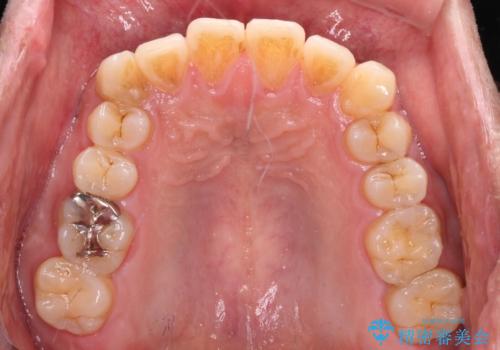遠方からの通院 インビザライン矯正治療の治療中