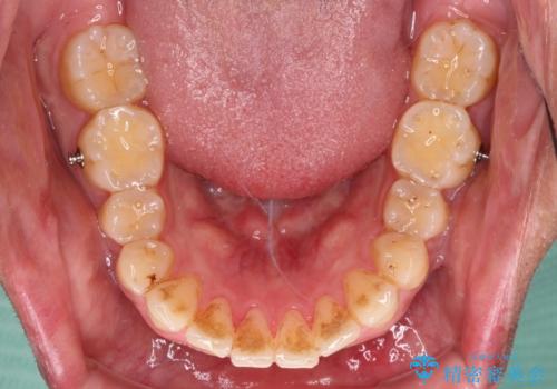 遠方からの通院 インビザライン矯正治療の治療中