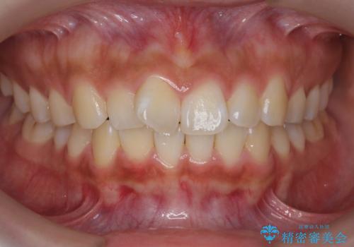 ワイヤーの小矯正を行い、治療期間を短縮するマウスピース治療の治療前