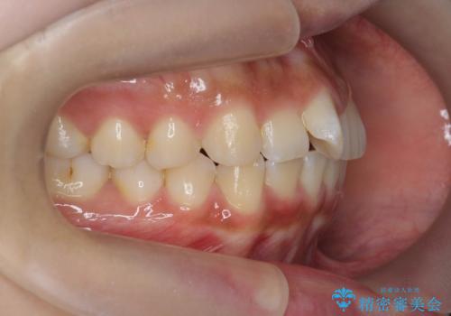 ワイヤーの小矯正を行い、治療期間を短縮するマウスピース治療の治療前
