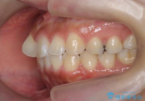 ワイヤーの小矯正を行い、治療期間を短縮するマウスピース治療の治療前