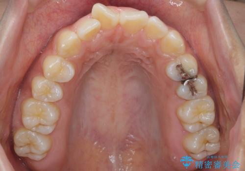 ワイヤーの小矯正を行い、治療期間を短縮するマウスピース治療の治療前