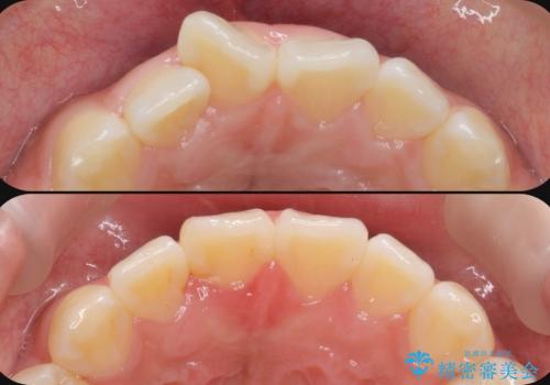 ワイヤーの小矯正を行い、治療期間を短縮するマウスピース治療