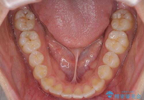 ワイヤーの小矯正を行い、治療期間を短縮するマウスピース治療の治療前