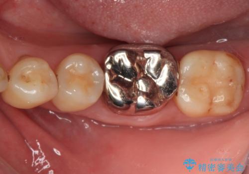 口を開けたときに目立つ銀歯 オールセラミック治療の治療前