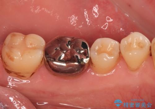 口を開けたときに目立つ銀歯 オールセラミック治療の治療前