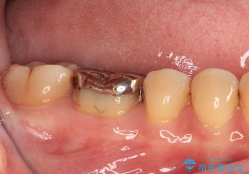 口を開けたときに目立つ銀歯 オールセラミック治療の治療前