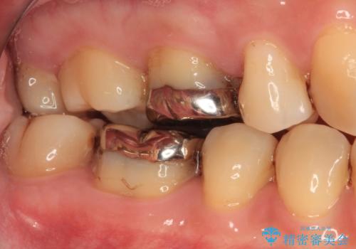 口を開けたときに目立つ銀歯 オールセラミック治療の治療前