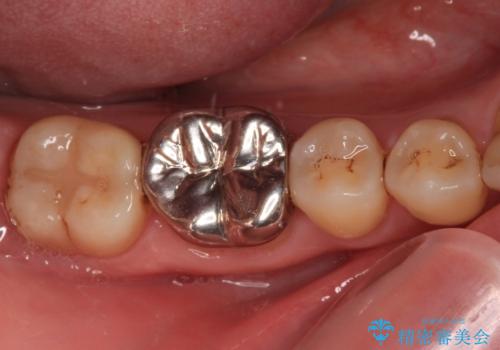 口を開けたときに目立つ銀歯 オールセラミック治療の治療前