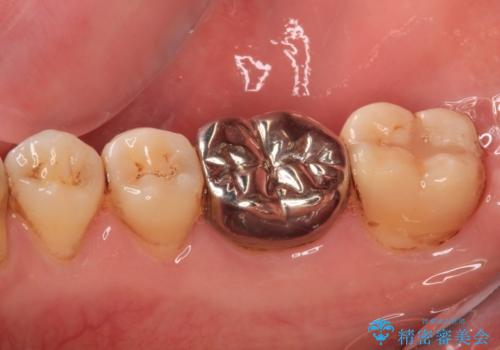 口を開けたときに目立つ銀歯 オールセラミック治療の治療前