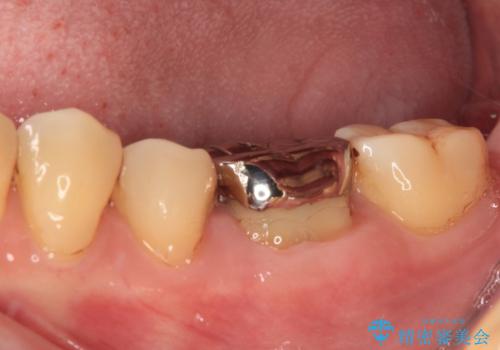 口を開けたときに目立つ銀歯 オールセラミック治療の治療前