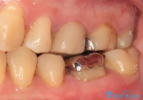 口を開けたときに目立つ銀歯 オールセラミック治療の治療前