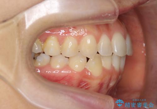 前歯のがたつきをしっかり治すマウスピース矯正の治療中