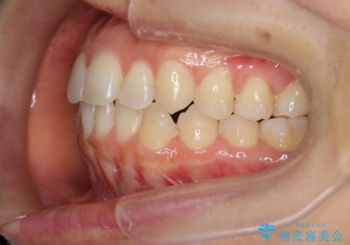 前歯のがたつきをしっかり治すマウスピース矯正の治療中