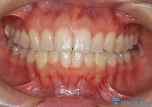 前歯のがたつきをしっかり治すマウスピース矯正の治療中