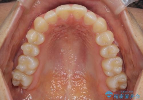 前歯のがたつきをしっかり治すマウスピース矯正の治療中