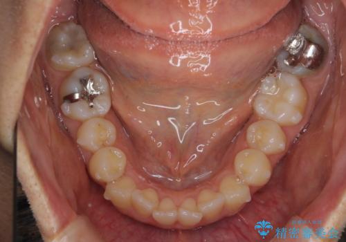 前歯のがたつきをしっかり治すマウスピース矯正の治療中