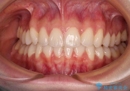 前歯のデコボコと深い咬み合わせ　インビザラインできれいに改善の治療後
