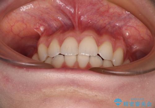 前歯のデコボコと深い咬み合わせ インビザラインできれいに改善の治療後