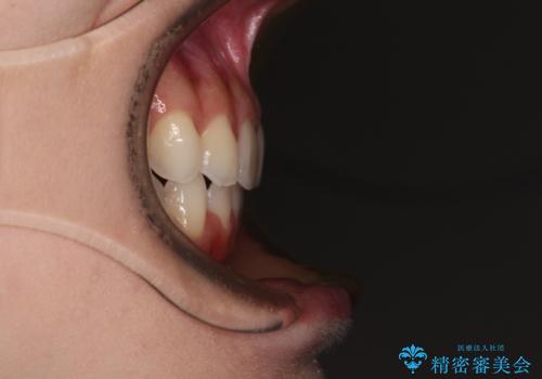 前歯のデコボコと深い咬み合わせ インビザラインできれいに改善の治療後