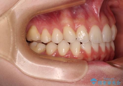 前歯のデコボコと深い咬み合わせ インビザラインできれいに改善の治療後